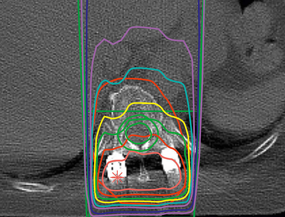 Dose planning for radiotherapy with BlackArmor® pedicle screws