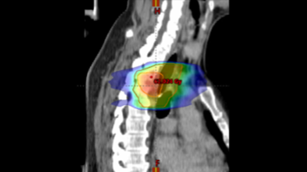 Strahlentherapieplanung im sagittalen CT