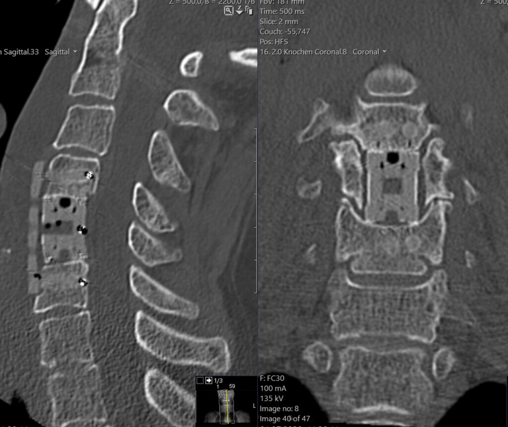 CT (links: sagittal, rechts: koronar)