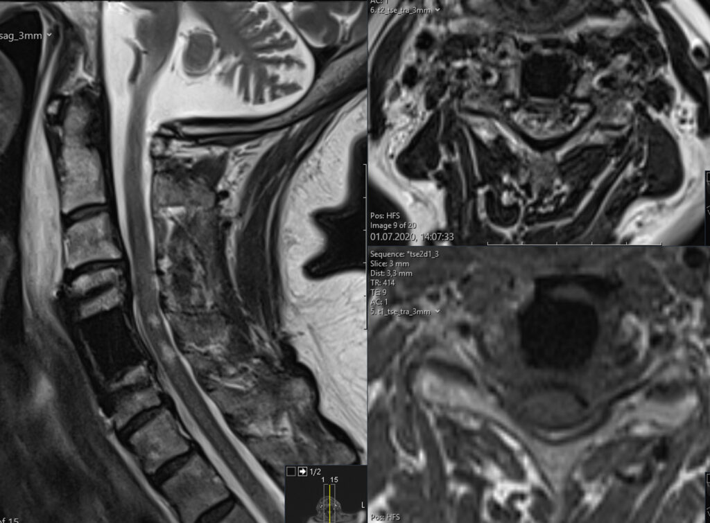 MRI (left: sagittal, right: axial)